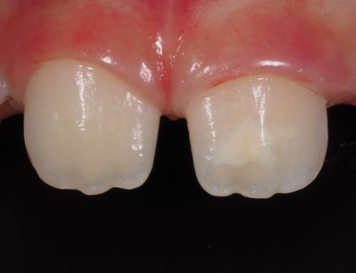 MIH – cosa sono quelle macchie sugli incisivi?