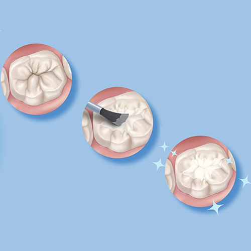 Sigillo Denti Bambini