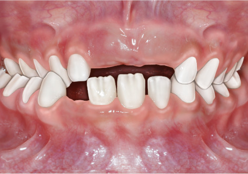 Palato stretto Bambino di 6 anni