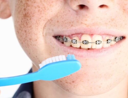 Come lavare i denti con l’apparecchio