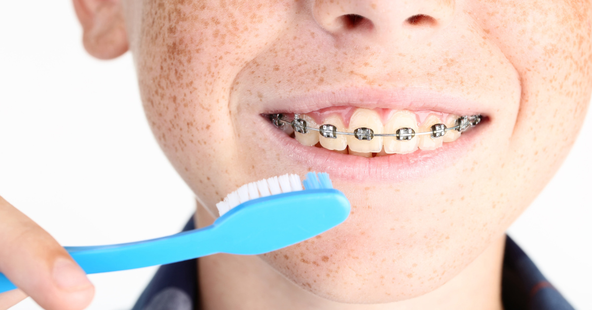 Come lavare i denti con l'apparecchio